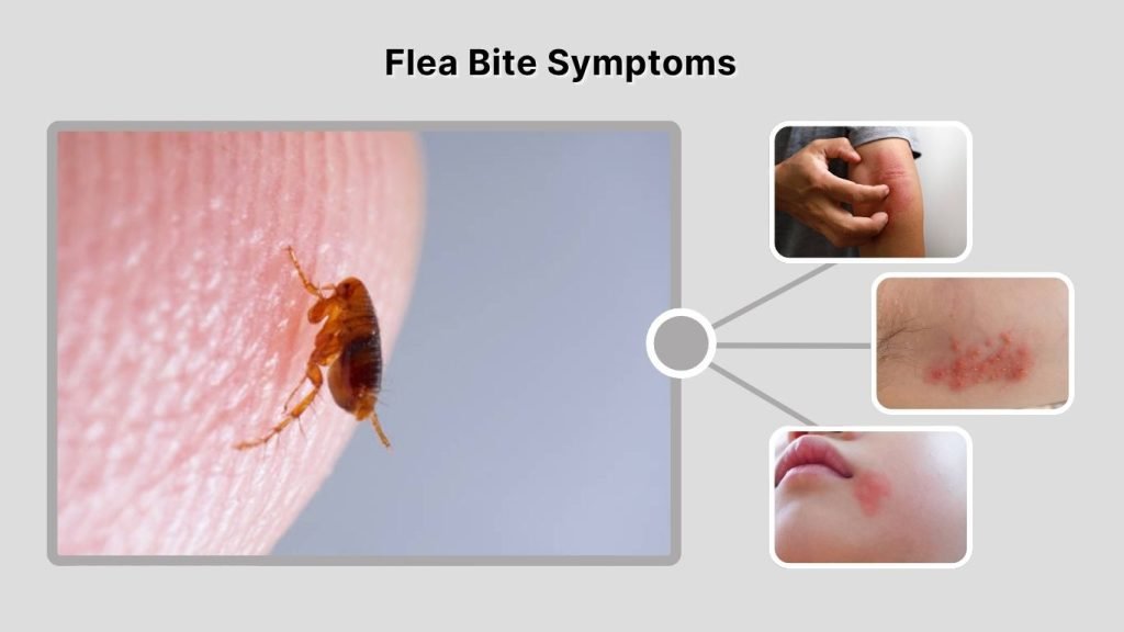 Flea Bite Symptoms