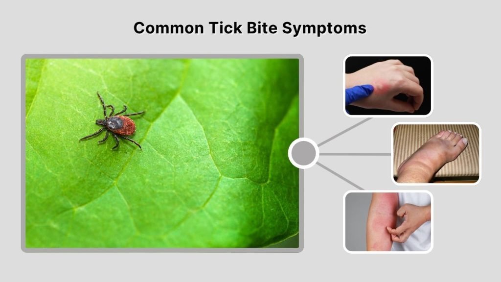 Common Tick Bite Symptoms