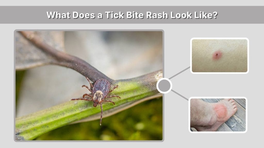 Tick Bite Rash: Symptoms, Causes, and When to Worry