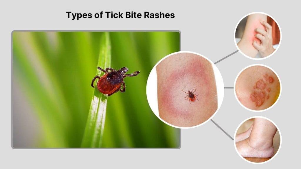 Tick Bite Rash: Symptoms, Causes, and When to Worry