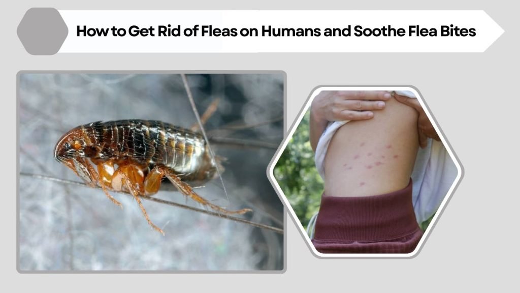 How to Get Rid of Fleas on Humans and Soothe Flea Bites