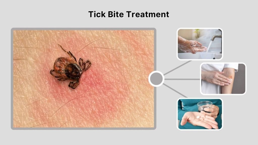 Tick Bite Treatment