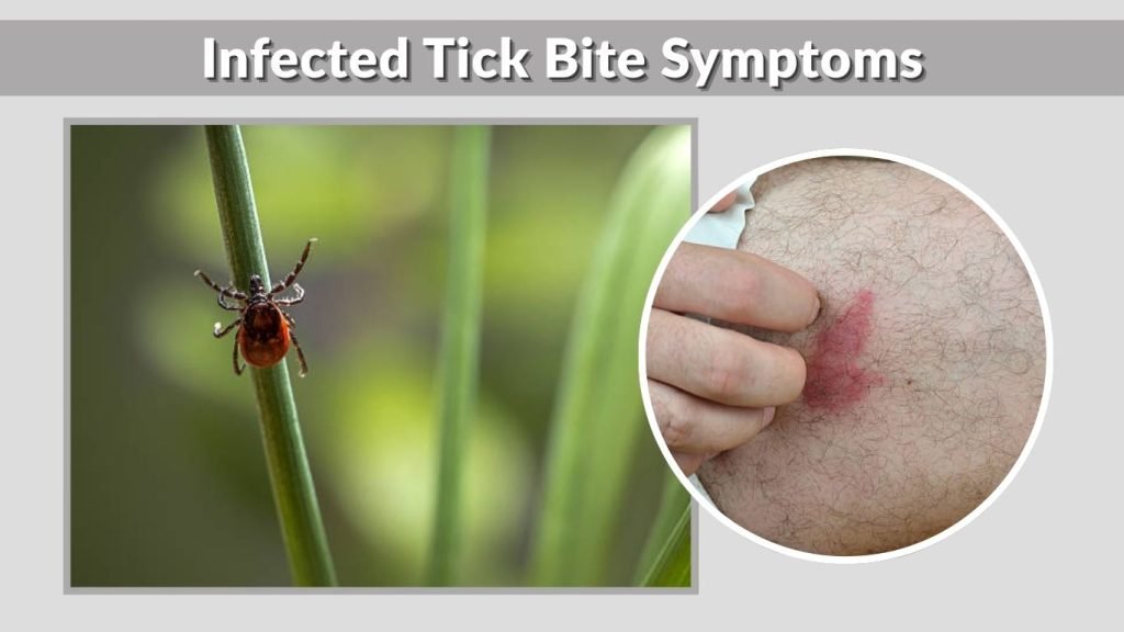 Infected Tick Bite Symptoms