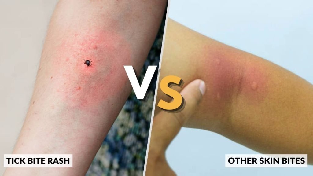 Tick Bite Rash vs Other Skin Bites