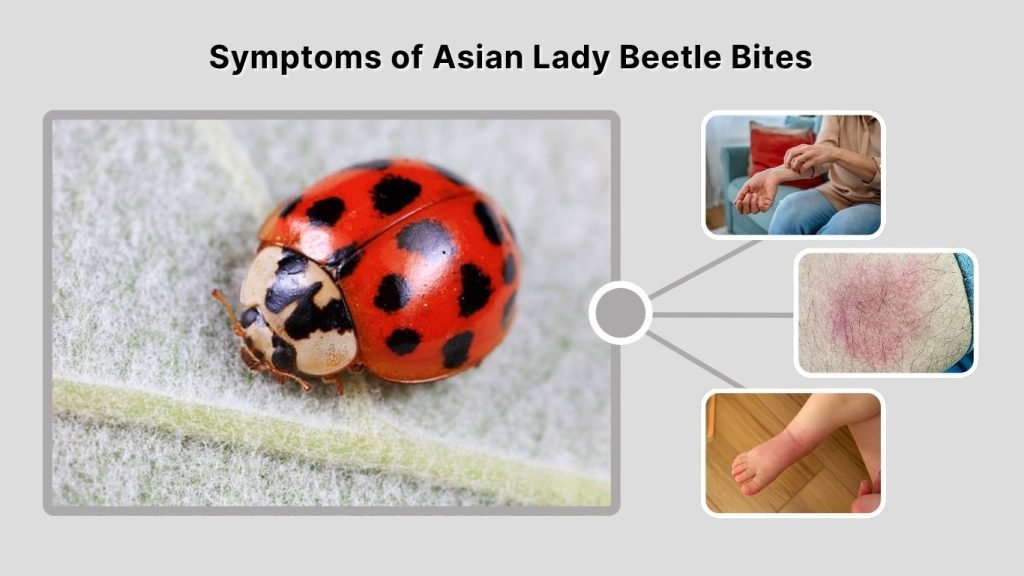 Symptoms of Asian Lady Beetle Bites