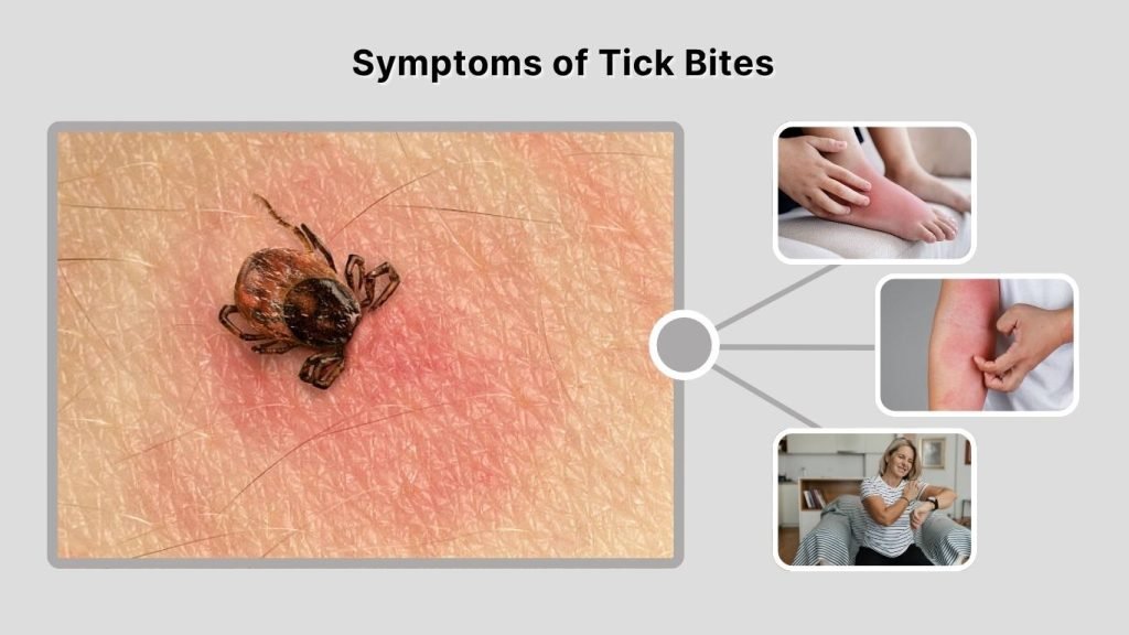 Symptoms of Tick Bites