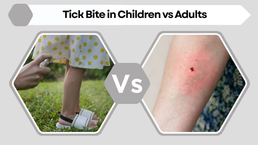 Tick Bite in Children vs Adults