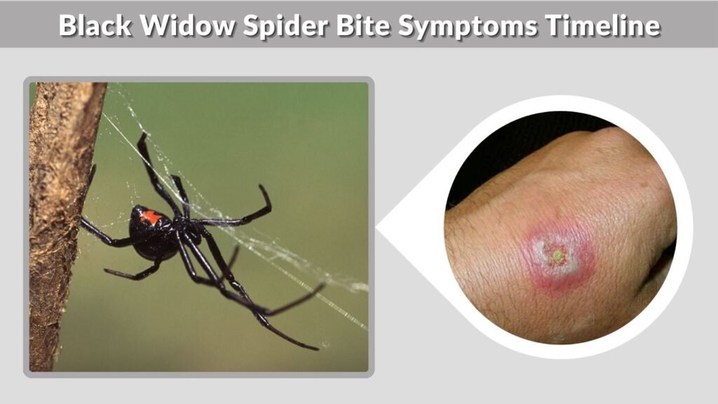 Black Widow Spider Bite Symptoms Timeline