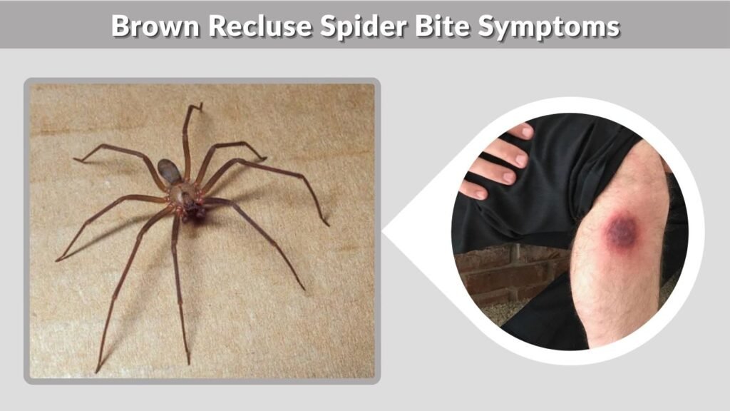 Brown Recluse Spider Bite Symptoms