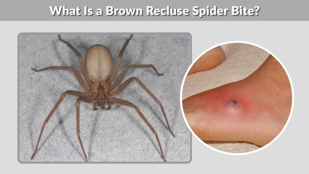 What Is a Brown Recluse Spider Bite?