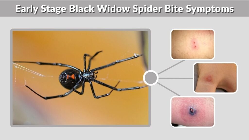 Early Stage Black Widow Spider Bite Symptoms