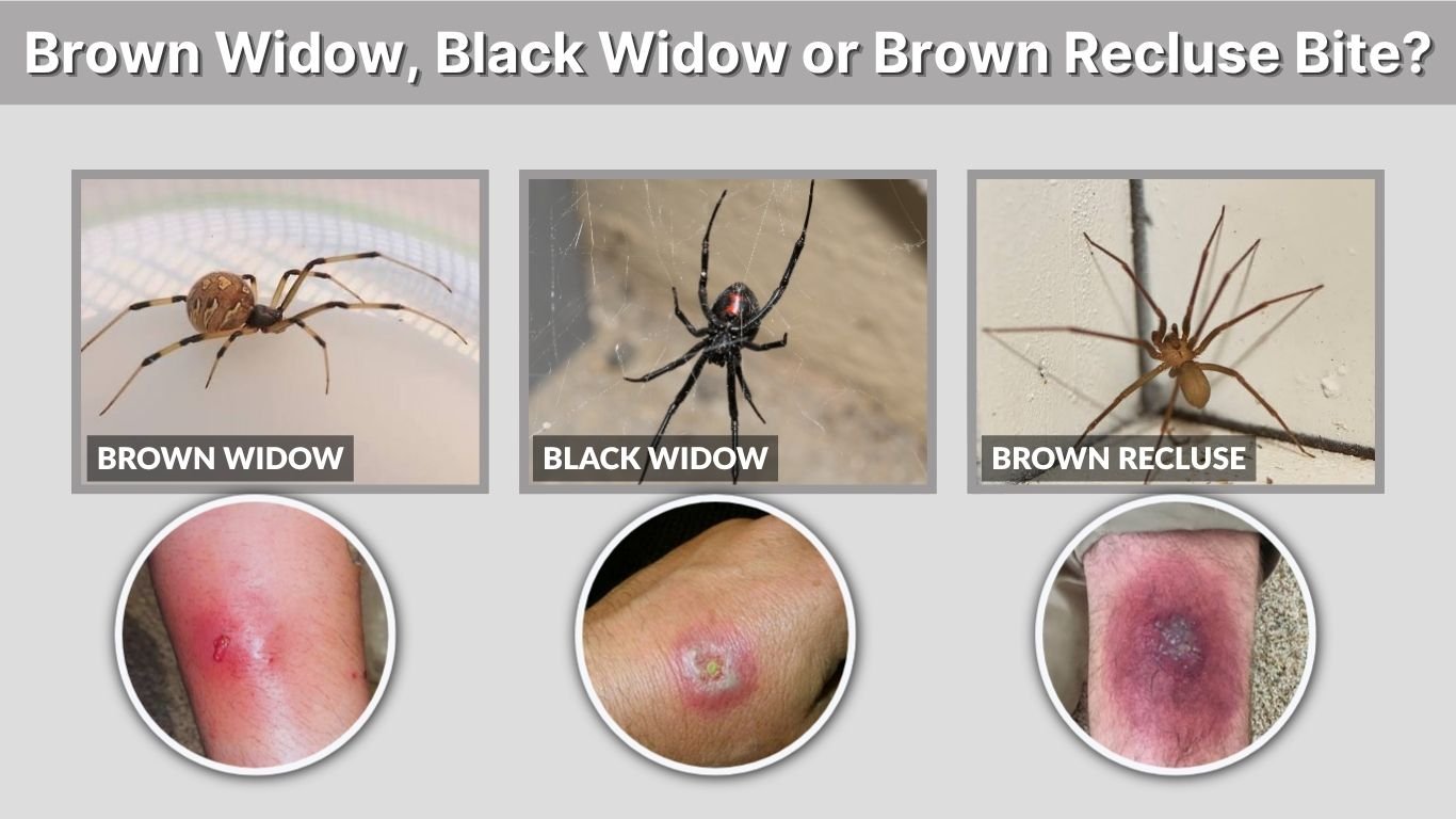 Brown Widow, Black Widow or Brown Recluse Bite?