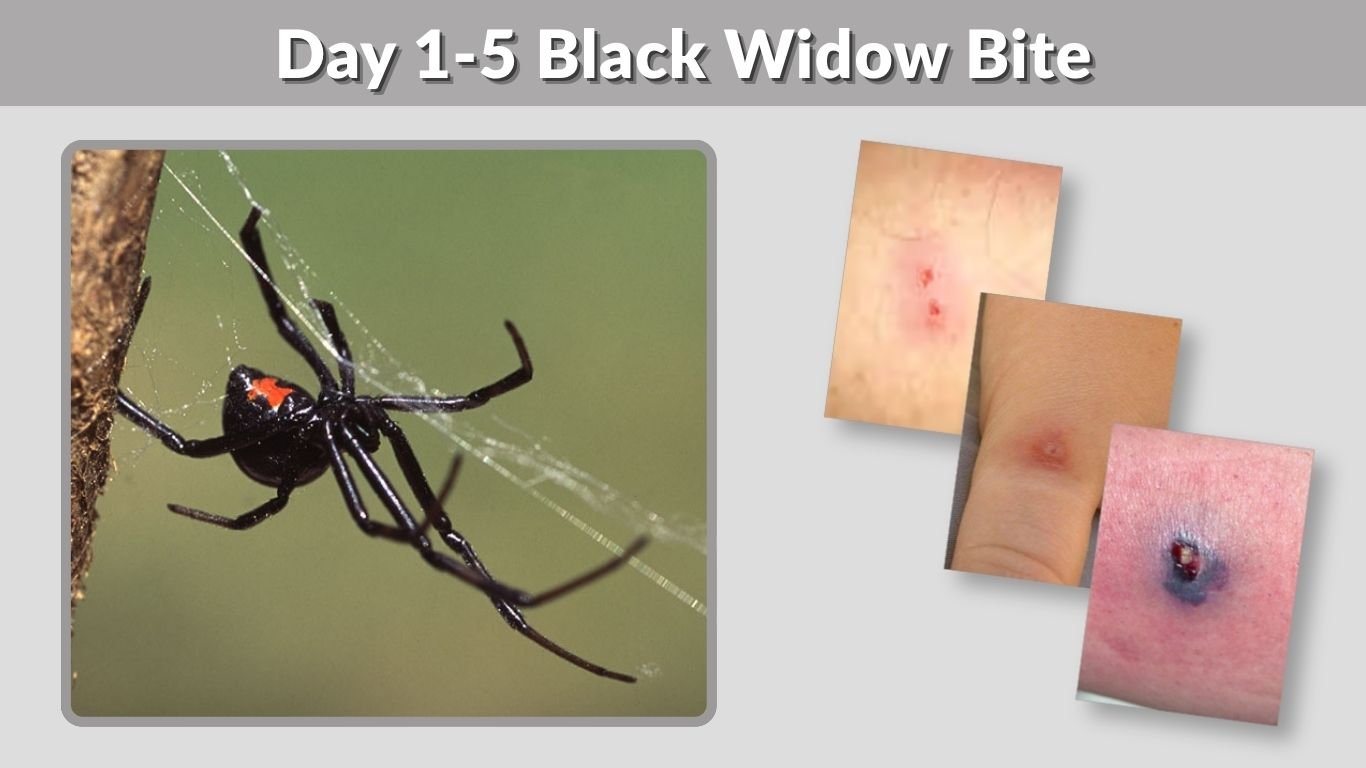 Day 1-5 Black Widow Bite: Early Symptoms and Warning Signs