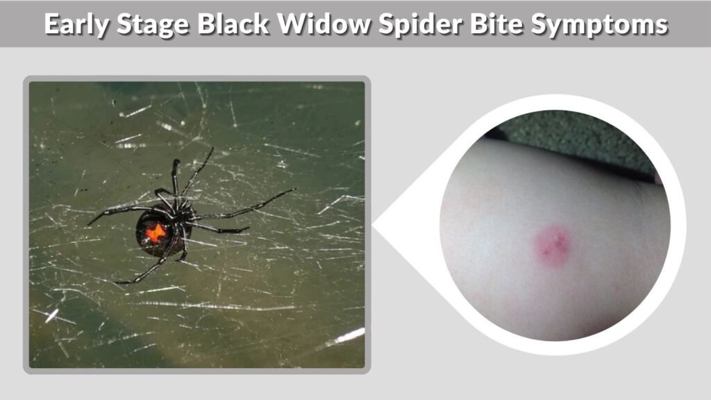 Early Stage Black Widow Spider Bite Symptoms
