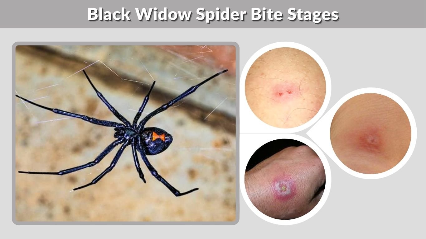 Black Widow Spider Bite Stages: Timeline, Symptoms & Care