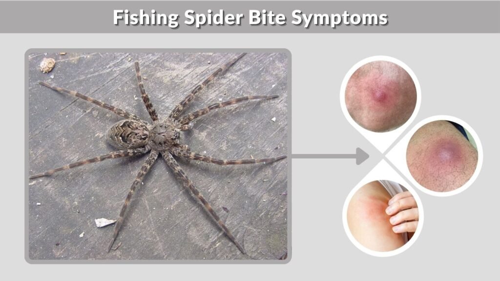 Fishing Spider Bite Symptoms