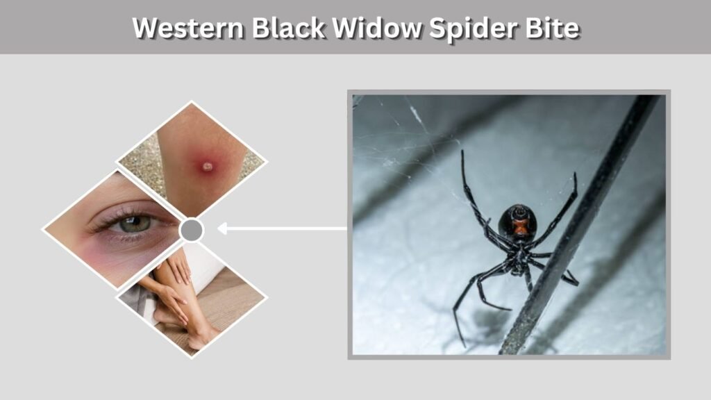 Western Black Widow Spider Bite