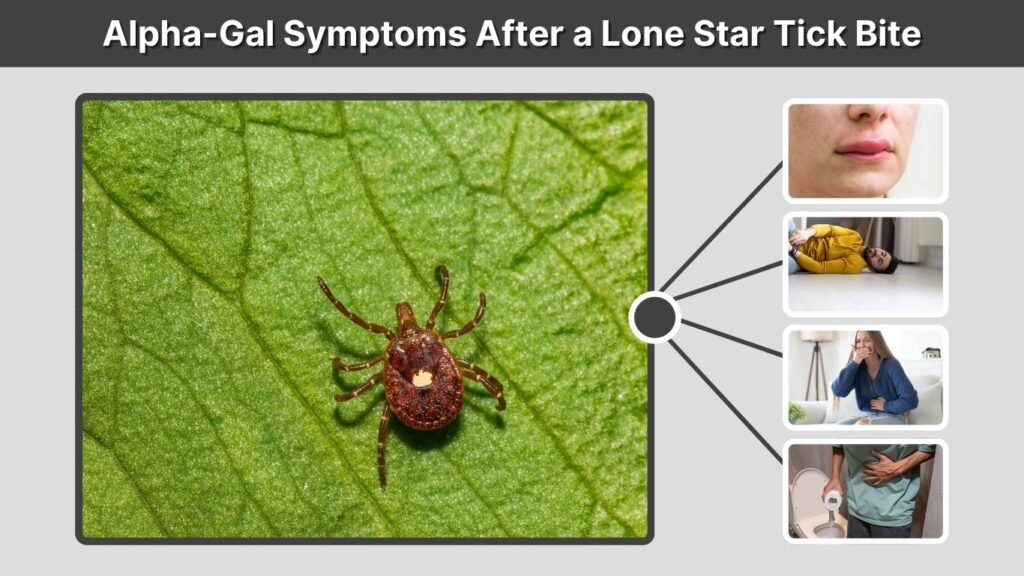 Alpha-Gal Symptoms After a Lone Star Tick Bite