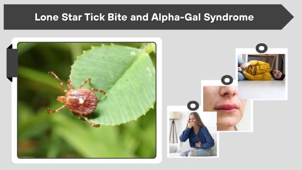 Lone Star Tick Bite and Alpha-Gal Syndrome