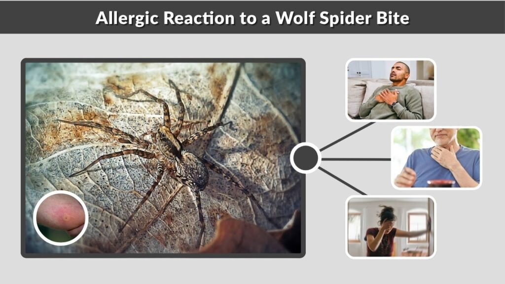 Allergic Reaction to a Wolf Spider Bite