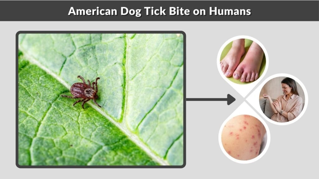 American Dog Tick Bite on Humans