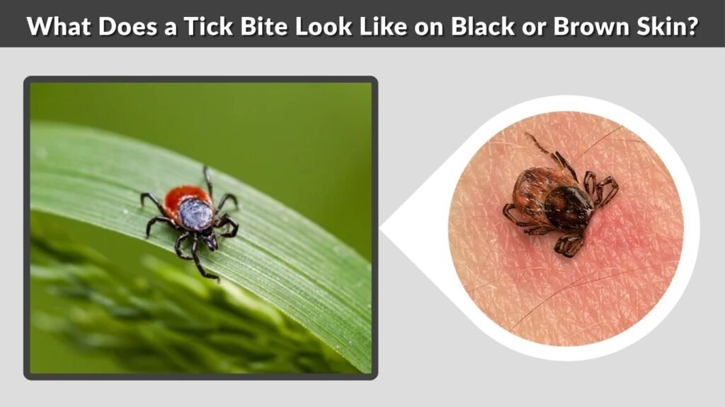 What Does a Tick Bite Look Like on Black or Brown Skin?