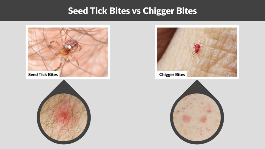 Seed Tick Bites vs Chigger Bites