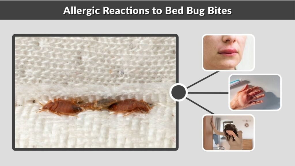 Allergic Reactions to Bed Bug Bites