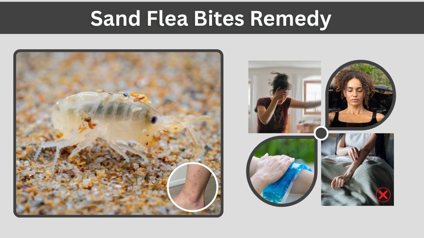 Sand Flea Bites Remedy: Best Home Treatments & Relief