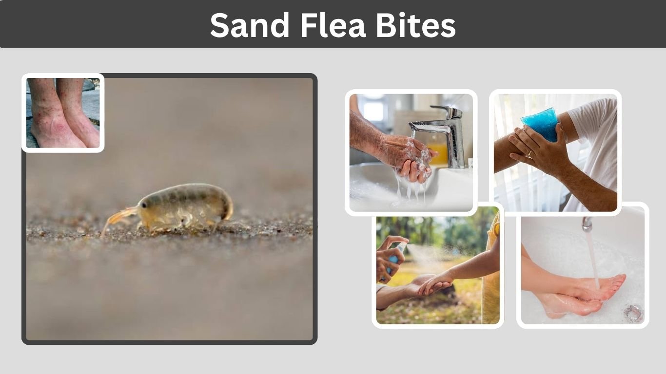 Sand Flea Bites: What They Look Like and How to Treat