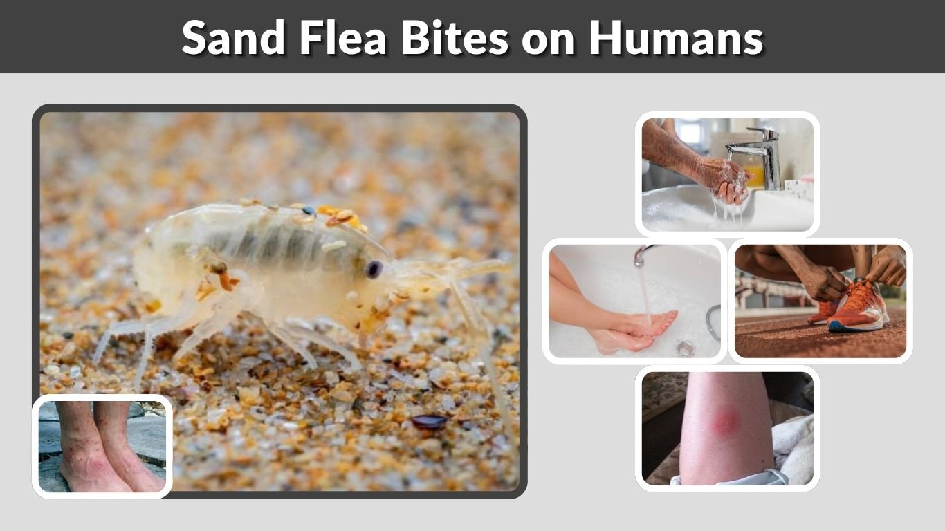 Sand Flea Bites on Humans: Signs, Treatment & Relief