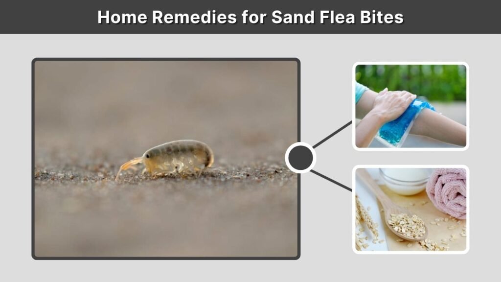 Home Remedies for Sand Flea Bites