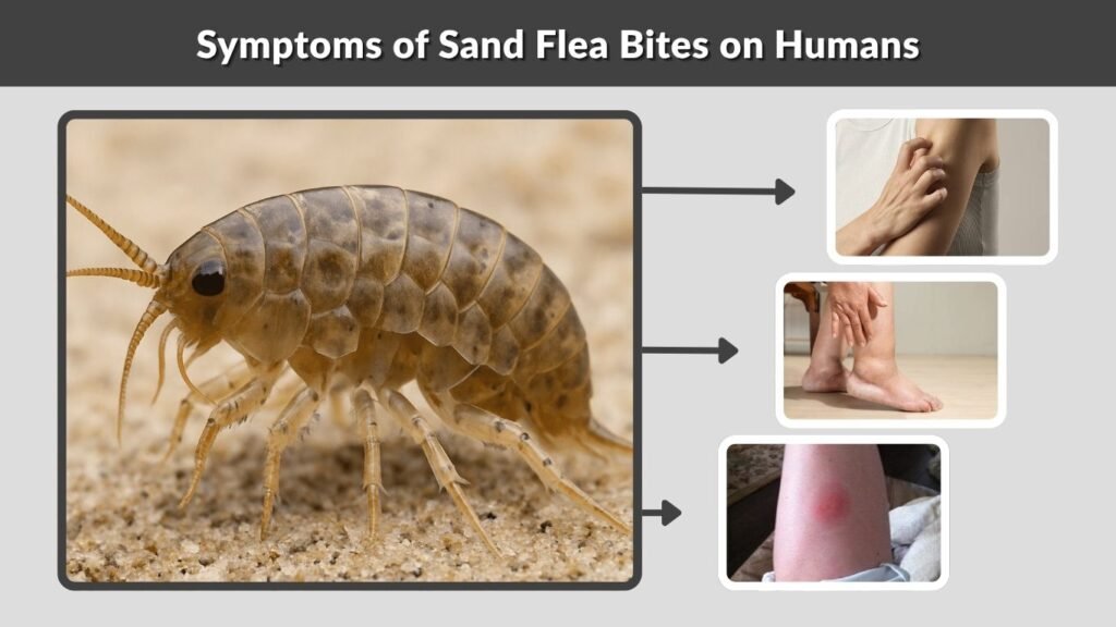Symptoms of Sand Flea Bites on Humans