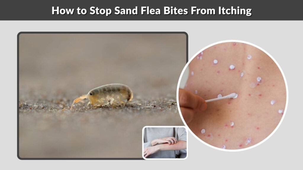 How to Stop Sand Flea Bites From Itching