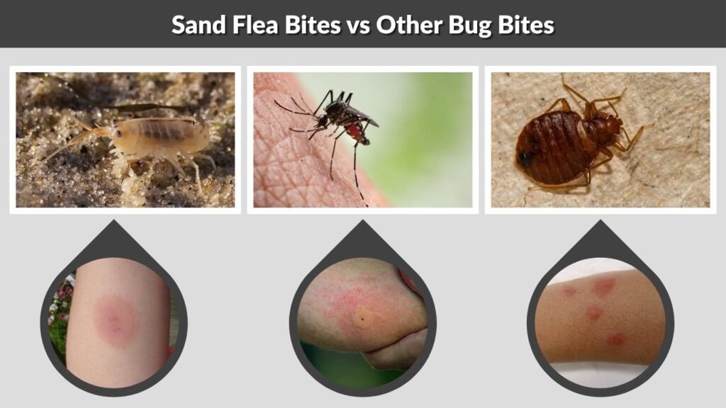 Sand Flea Bites vs Other Bug Bites
