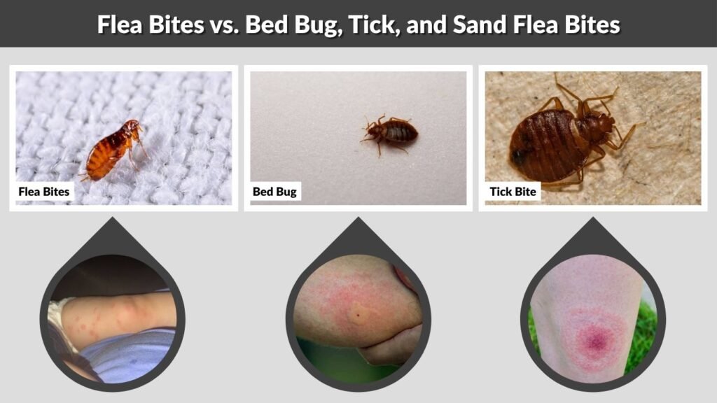 Flea Bites vs. Bed Bug, Tick, and Sand Flea Bites