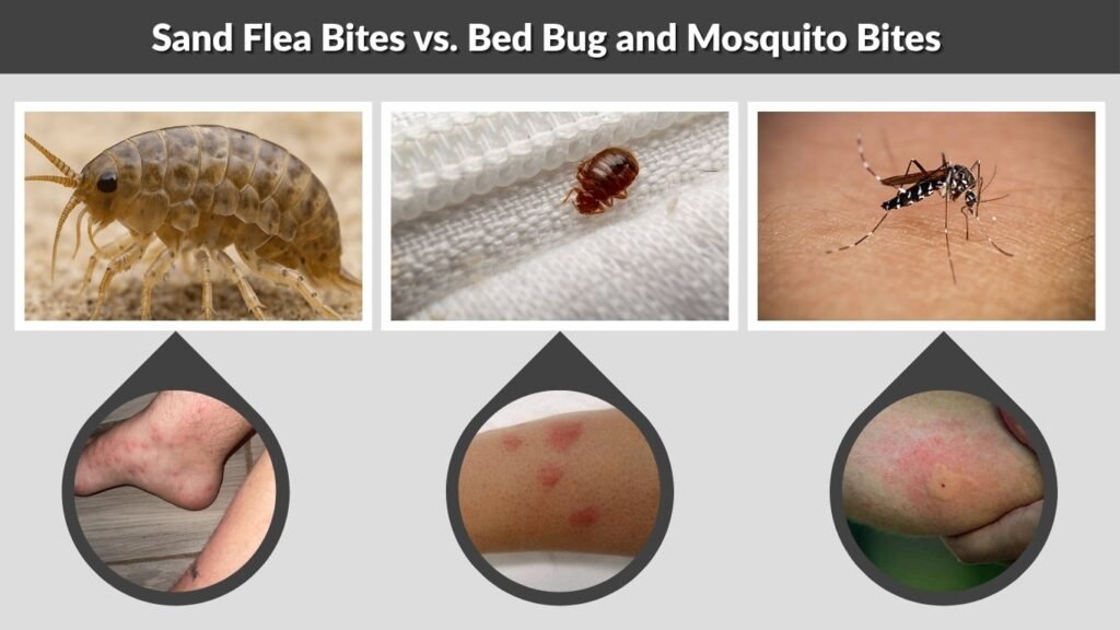 Sand Flea Bites vs. Bed Bug and Mosquito Bites