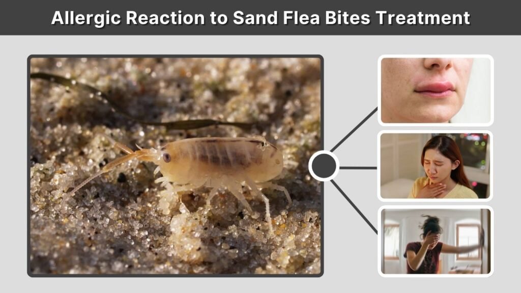 Allergic Reaction to Sand Flea Bites Treatment